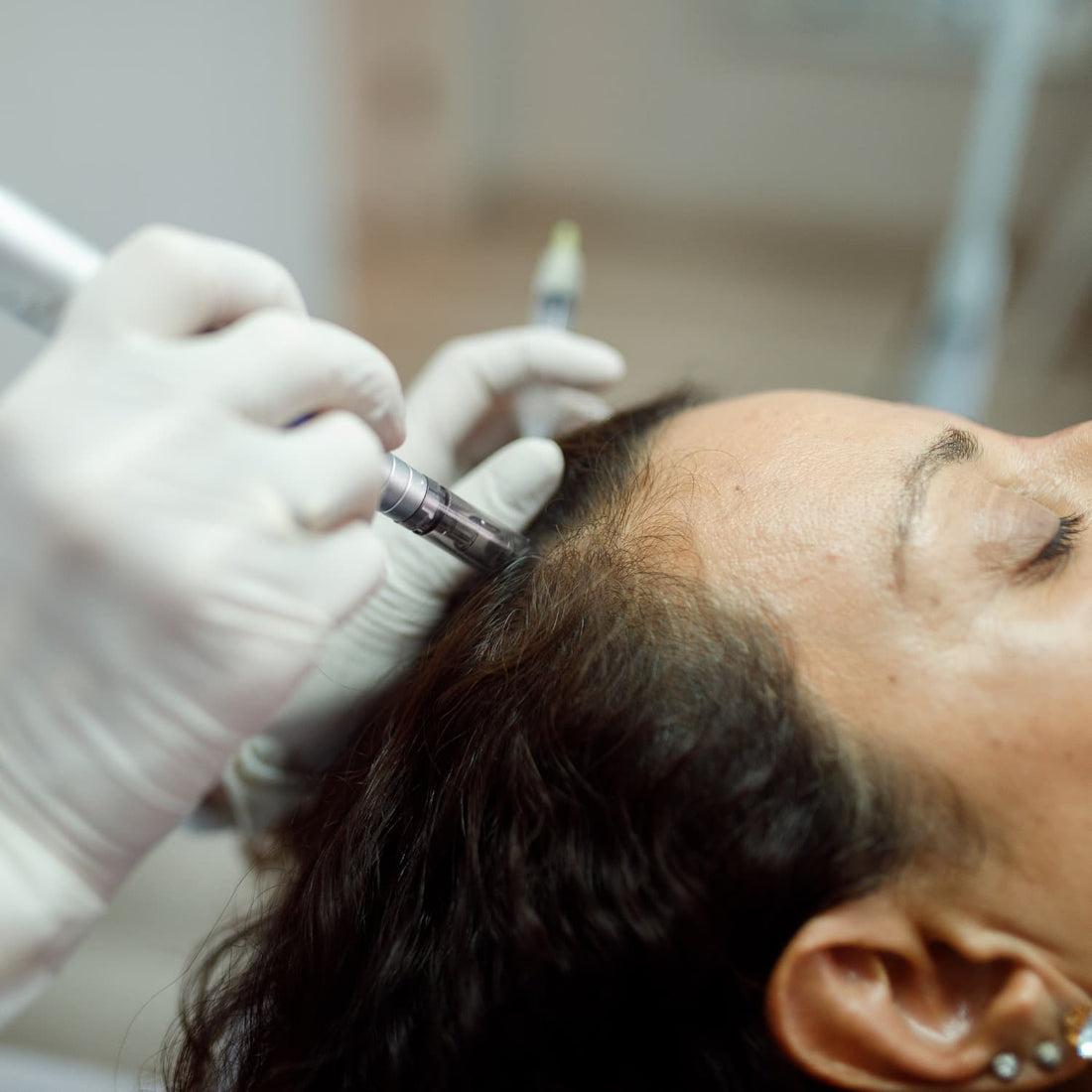 microneedling for hair growth