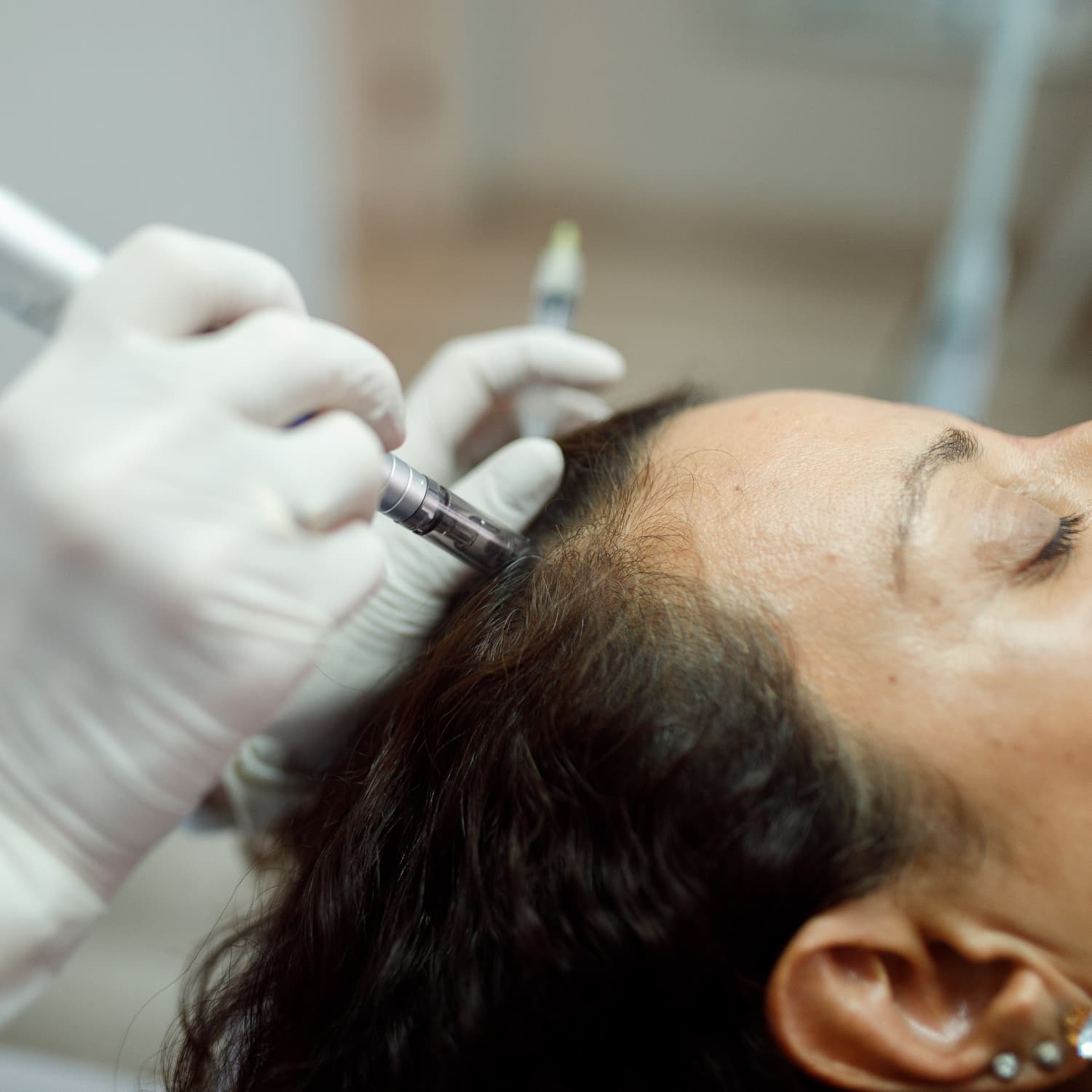 microneedling for hair growth